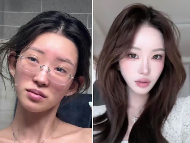 Choi Jun Hee гэрлэснээсээ гуравхан сарын дараа дахин мэс засалд орох гэж байгаагаа зарлав 2 Choi Jun Hee гэрлэснээсээ гуравхан сарын дараа дахин мэс засалд орох гэж байгаагаа зарлав