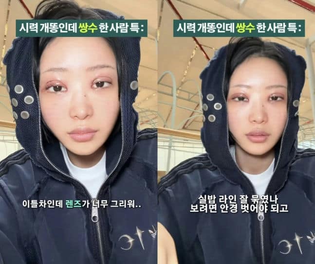 Choi Jun-hee давхар зовхины хагалгааны дараах хавдсан төрхөө ил болгожээ 2 Choi Jun-hee давхар зовхины хагалгааны дараах хавдсан төрхөө ил болгожээ