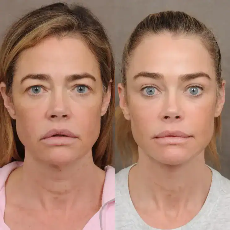 55 настай Denise Richards нүүр татуулах мэс заслаа илчиллээ: “Өөрийнхөө төлөө хийсэн хамгийн зөв зүйл” 2 55 настай Denise Richards нүүр татуулах мэс заслаа илчиллээ: “Өөрийнхөө төлөө хийсэн хамгийн зөв зүйл”