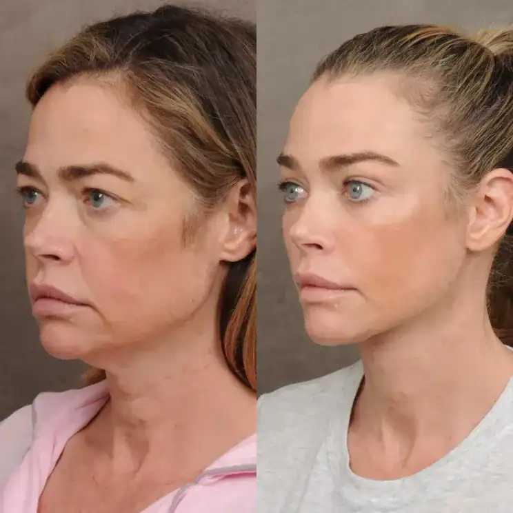 55 настай Denise Richards нүүр татуулах мэс заслаа илчиллээ: “Өөрийнхөө төлөө хийсэн хамгийн зөв зүйл” 3 55 настай Denise Richards нүүр татуулах мэс заслаа илчиллээ: “Өөрийнхөө төлөө хийсэн хамгийн зөв зүйл”